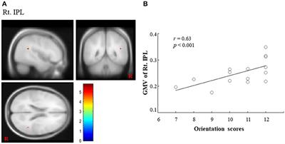 Decreased Gray Matter Volume of Right Inferior Parietal Lobule Is Associated With Severity of Mental <mark class="highlighted">Disorientation</mark> in Patients With Mild Cognitive Impairment